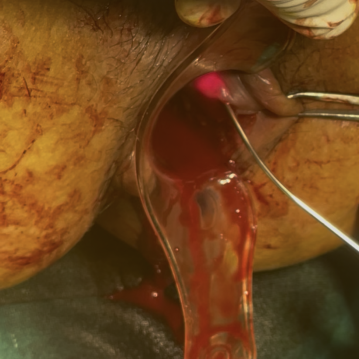 Modern Hemorrhoid Treatment: Painless Laser Surgery by Dr. Jayant Sah at Inova Hospital