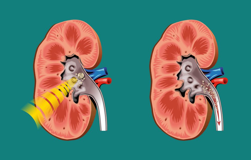 Kidney Stone Laser Treatment: A Advanced Solution by Expert Dr. Saroj Giri