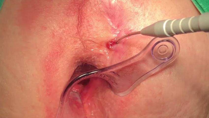 laser surgery for fistula