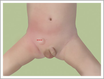 congenital hernia