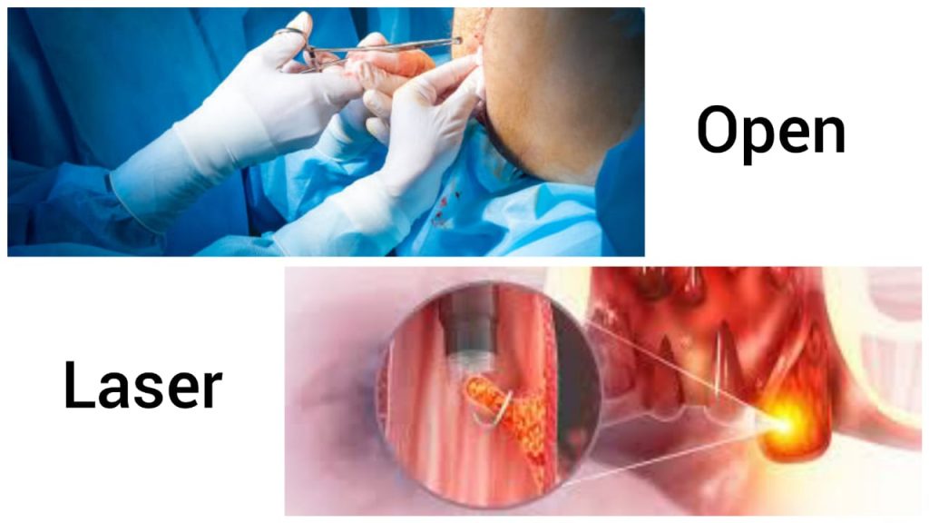 Laser vs. Open Surgery for Hemorrhoids